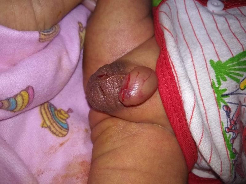 Kondisi kemaluan bayi 2 bulan di Lewoleba yang digigit anjing, Kamis (18/7) pagi